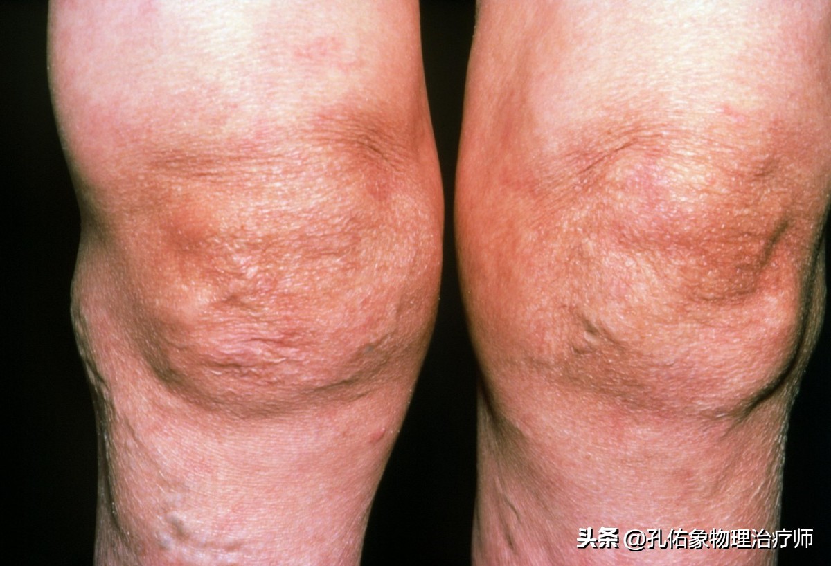 膝痛一招教你解决,膝痛怎样锻炼