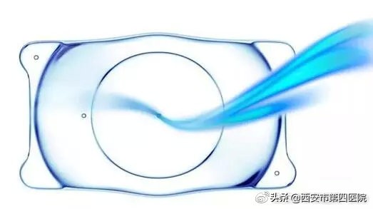 高度近视做的ICU手术有没有后遗症,高度近视做了icl手术后应注意什么