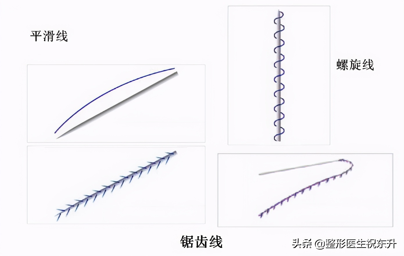 线雕隆鼻真相大揭秘,关于线雕十大热门问题解答