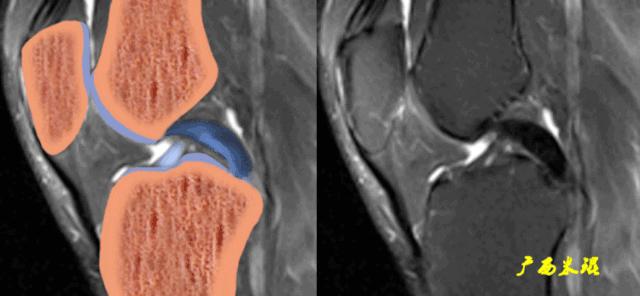 交叉韧带损伤的mr表现,后交叉韧带损伤的诊断实验