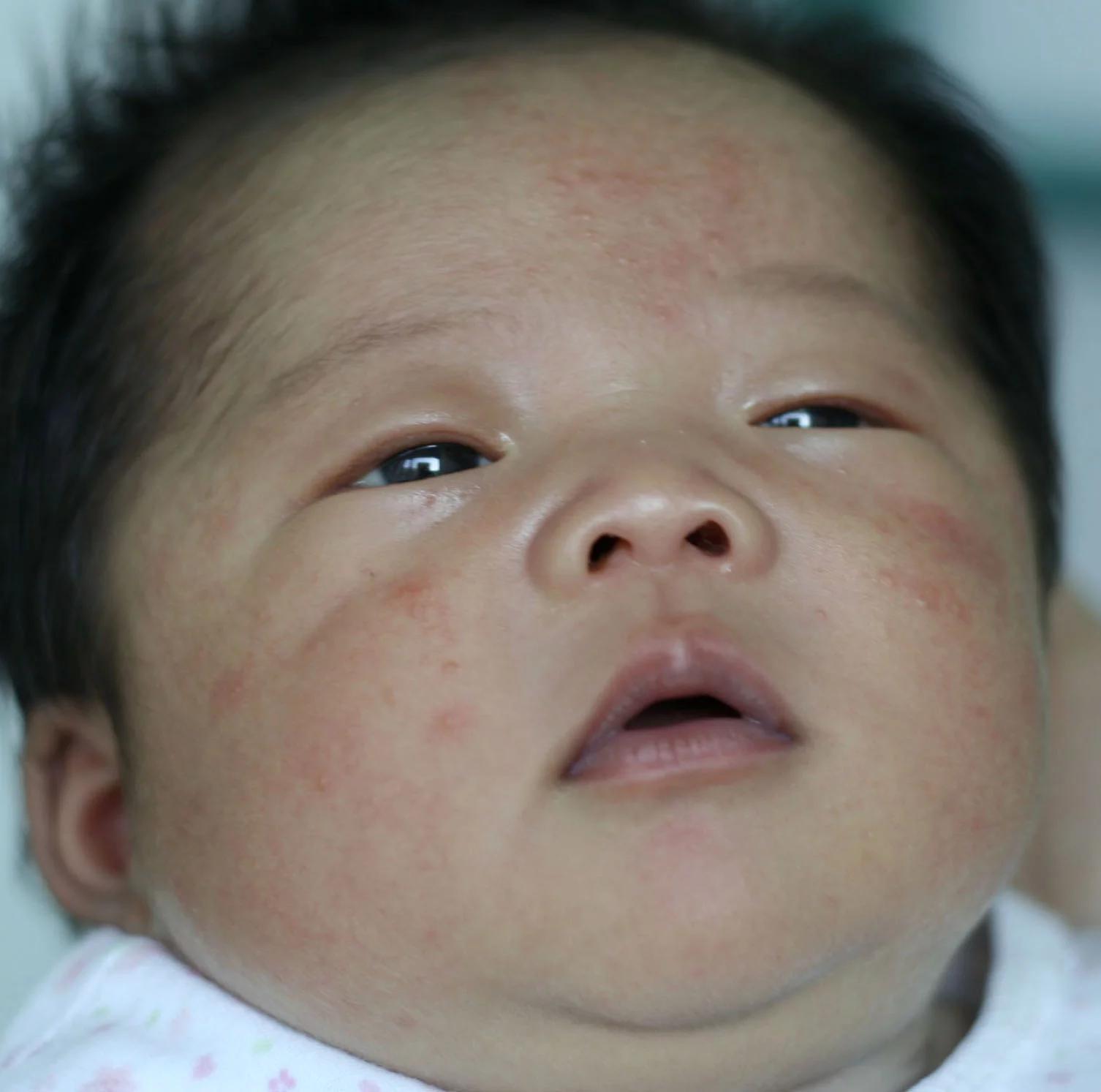 宝宝长湿疹到底怎么办,宝宝湿疹是因为妈妈上火吗