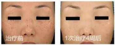 皮秒仪器原理,皮秒祛斑原神