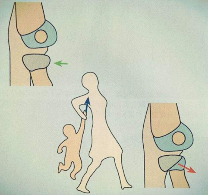 婴儿牵拉肘,小儿牵拉肘怎么办