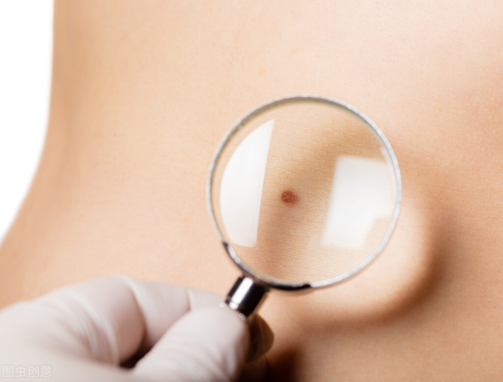 点痣留的疤能去掉吗,点痣抠掉了会留疤吗