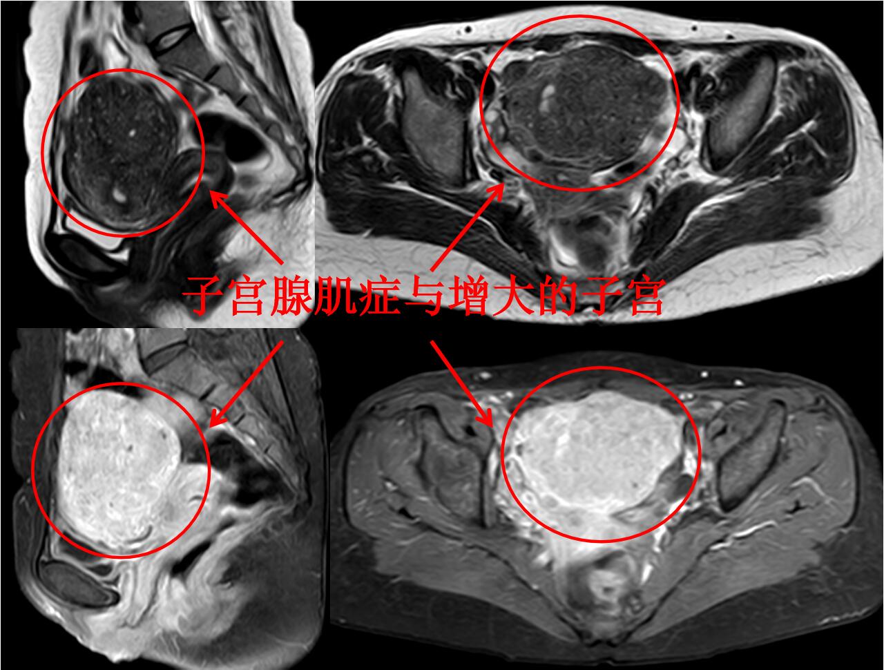 看看痛不欲生的子宫腺肌症痛经专业领域的看法与典型病例
