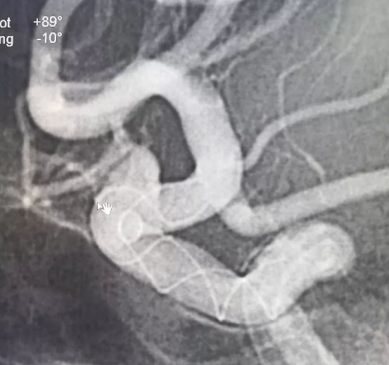 Tubridge®治疗多发性动脉瘤