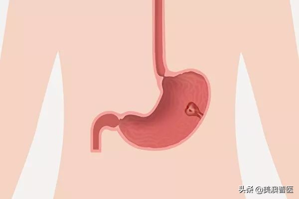 六个胃癌前病变,得了胃病不可再忽视