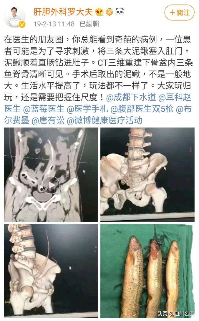 一条罗非鱼“游”进肛门？医生：直肠不直，进去容易出来难