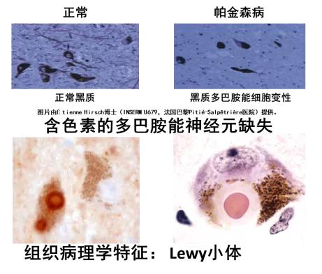 帕金森手部康复治疗,帕金森病能否被完全治愈医学科普