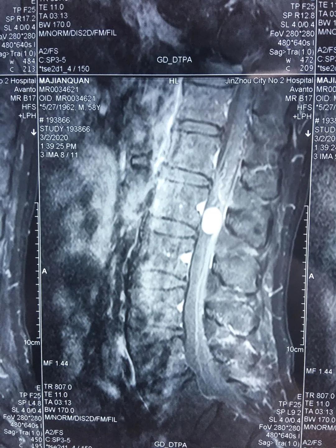 椎管内肿瘤辽宁省肿瘤医院能治吗,椎管内肿瘤手术做得好的医院