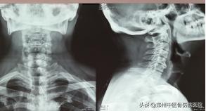 李氏砭法刮痧直播,李氏虎符铜砭刮痧治腰椎间盘突出