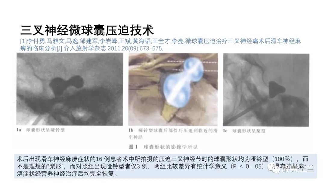 病例分享丨三叉神经节微球囊压迫术的麻醉管理