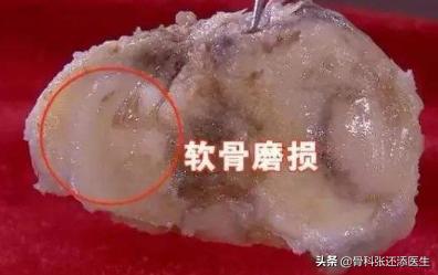 膝盖弯曲总是响是怎么回事,走路膝盖咯咯响有什么治疗方法