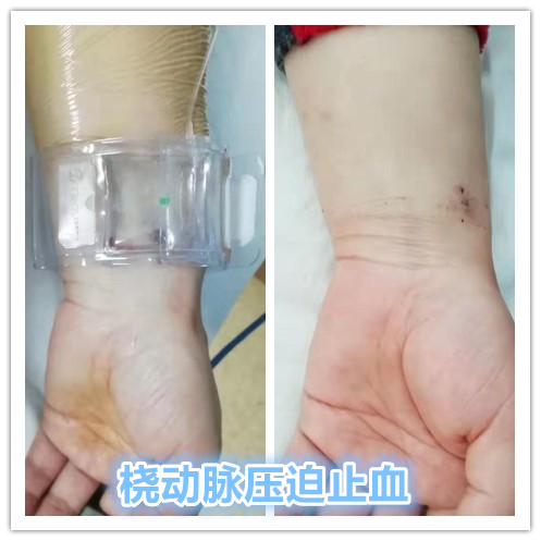 子宫腺肌症介入栓塞全国哪里好,子宫腺肌症介入栓塞治疗报销吗