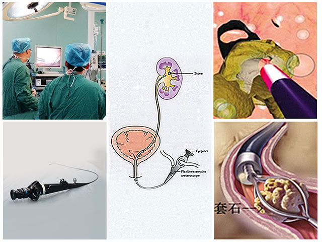 体外碎石做了三次肾结石又复发了,碎石三次了还没排出怎么回事