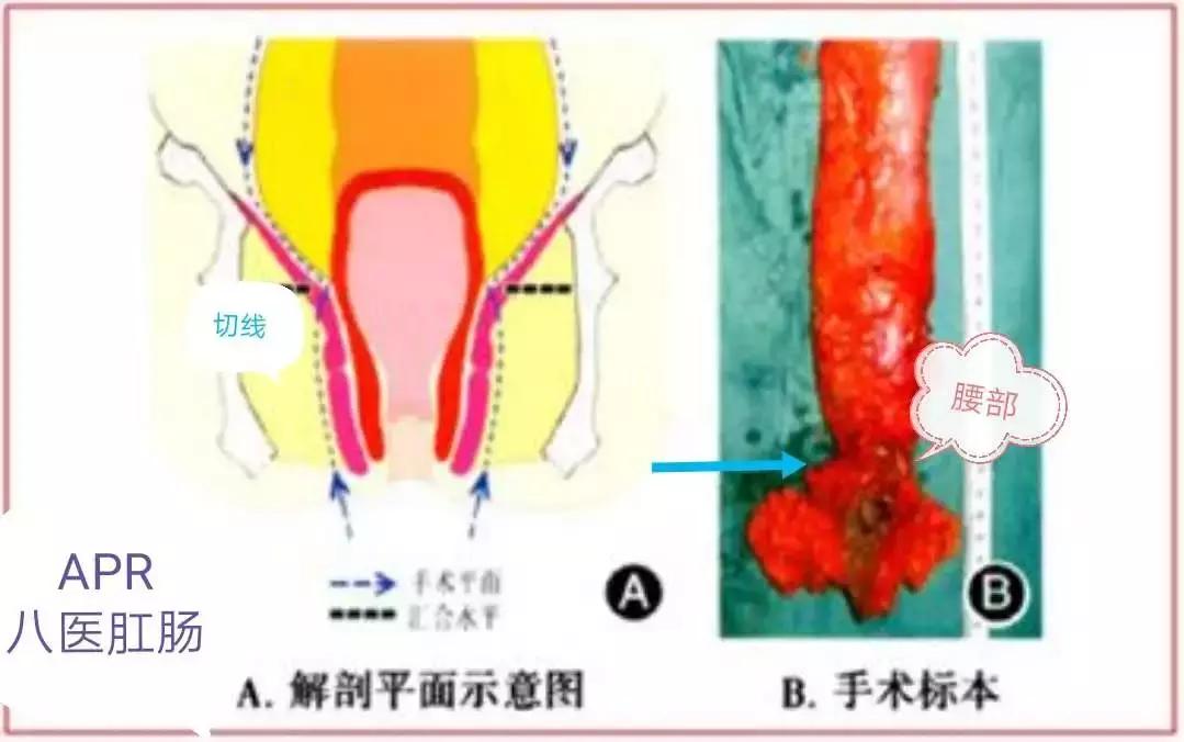 「技术」青岛市第八人民医院肛肠外科高难手术挽救低位直肠癌患者