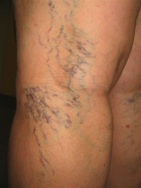 腿上有蜘蛛网是怎么回事,腿上结蜘蛛网是什么