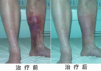 无精症患者的新希望,卵巢癌最新治疗新希望