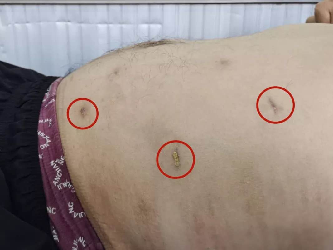 腹部手术后如何预防切口疝,腹部疝气手术并发症