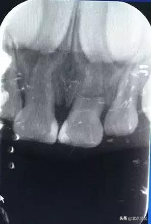 孩子牙磕掉一个角还能长吗,把握孩子的三个黄金关键期