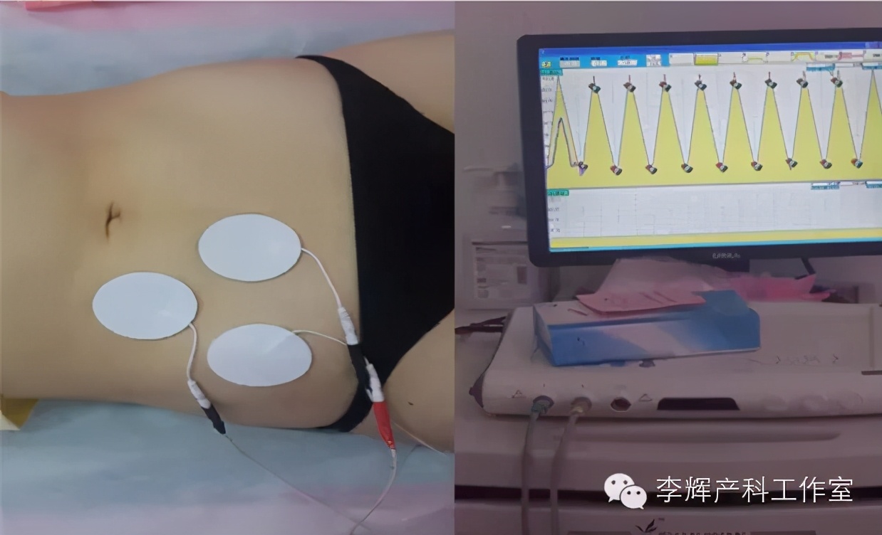 顺产后42天复查建议盆底康复治疗,产后42天复查医生要求做盆底康复