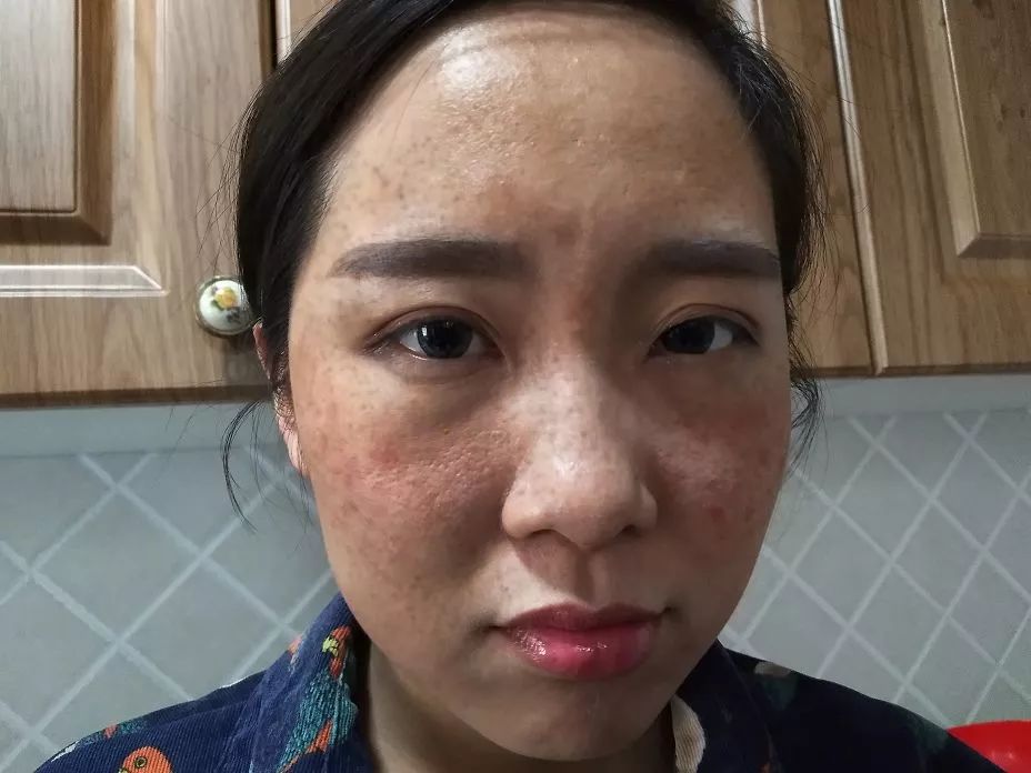 除皱小妙招,真性皱纹最快的除皱方法