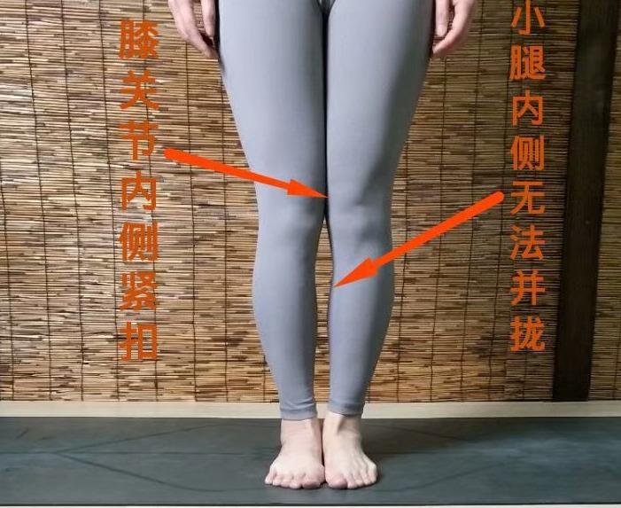 小腿外侧粗改善动作,小腿外扩和小腿外翻用什么矫正