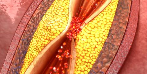 心脑血管病有斑块怎么办,心脑血管病有斑块怎么治疗