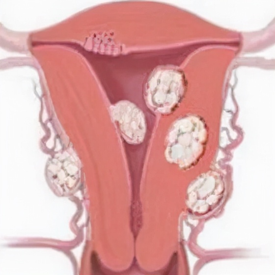 中医喊你来治疗慢性盆腔炎，多的是你不知道的优势