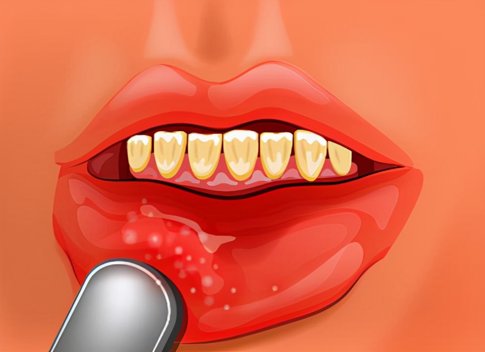 为什么口腔溃疡要疼到极致才会好,有一种不可言喻的痛苦叫口腔溃疡