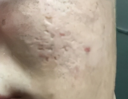 毛孔粗大别怕有办法,毛孔粗大了十几年还有救吗