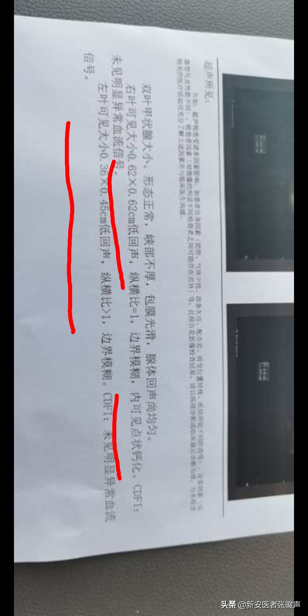 甲状腺b超4a癌变几率有多高,甲状腺4a中医治疗方法有效吗