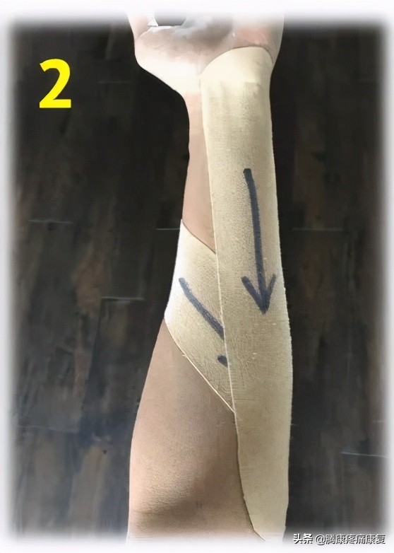 腕和手的多处屈肌和肌腱损伤,前臂神经卡压原因