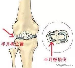 导致膝关节疼痛的原因有很多，防治方法有哪些？