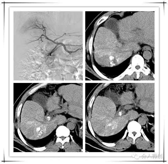 肝癌门静脉癌栓能做介入手术吗,肝癌门静脉癌栓中医治疗