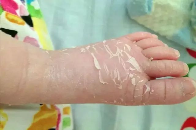 新生儿脱皮很严重是什么原因,新生儿有点脱皮什么原因