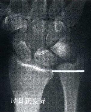 腕部三角纤维软骨损伤怎么办,腕部三角纤维软骨损伤形成原因