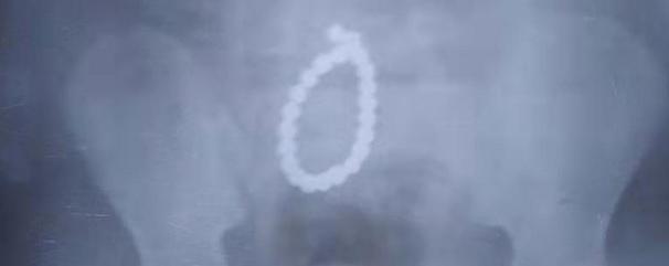 3岁女孩误吞12粒磁力珠,女童吞61颗磁力珠