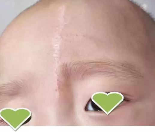 超减张缝合术哪里做的好,超减张精细缝合术如何修复疤痕