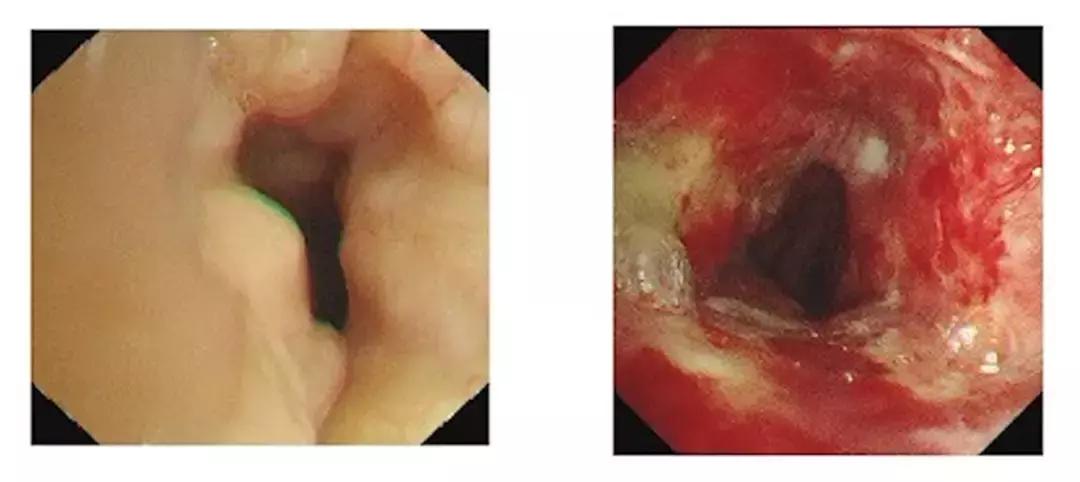 高位气管淀粉样变的处理|王洪武