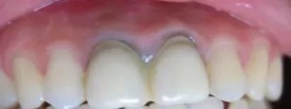 二氧化锆牙齿能做ct和核磁共振吗,氧化锆全锆牙冠能做核磁共振吗