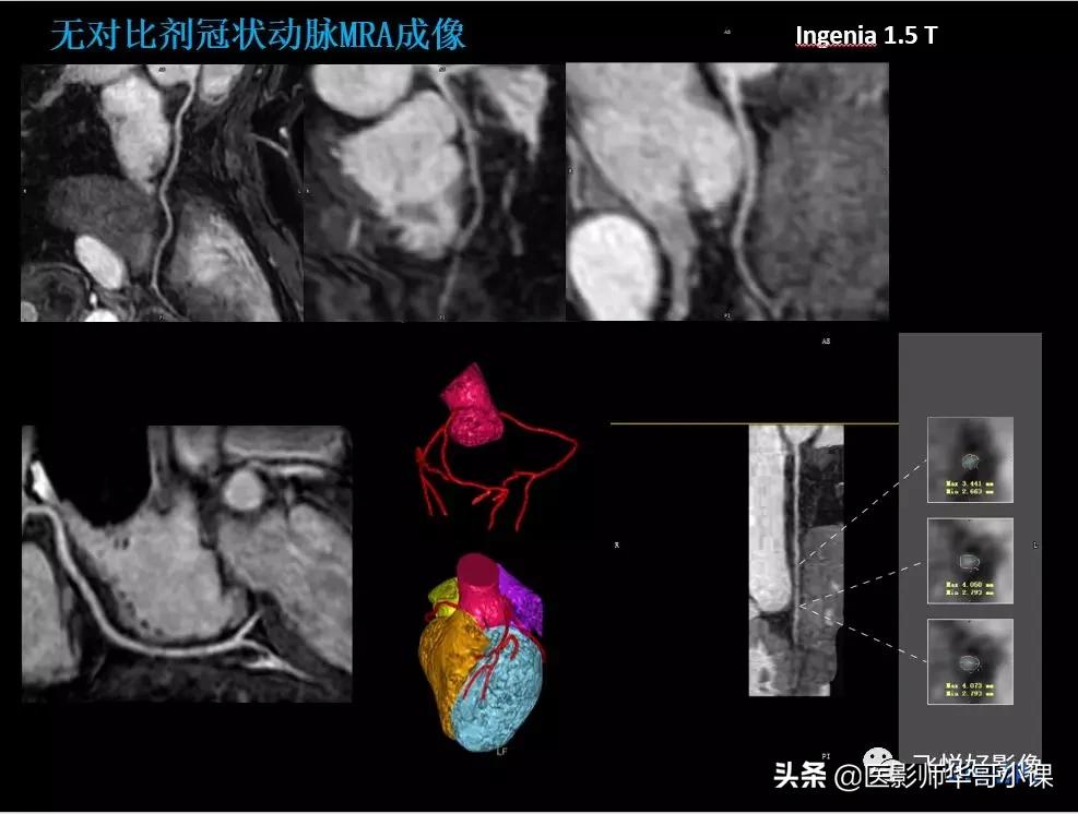 飞利浦多磁源核磁共振,飞利浦磁共振图像操作