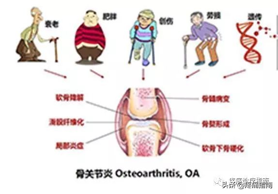 骨性关节炎诊疗指南,骨性关节炎诊疗指南欧美