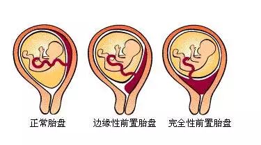 孕后期突然出血什么原因,孕早期出血8种情况已解决