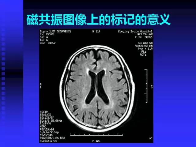 头颅mri读片视频教程,颅脑mri读片入门教程视频讲解全集