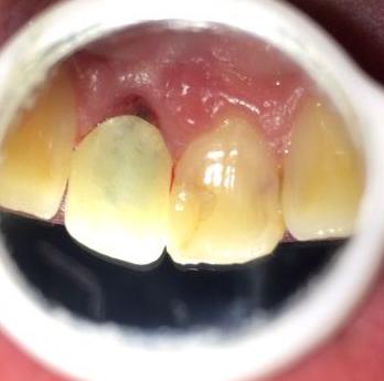 龋病最常见的修复方法,如何预防侧面龋
