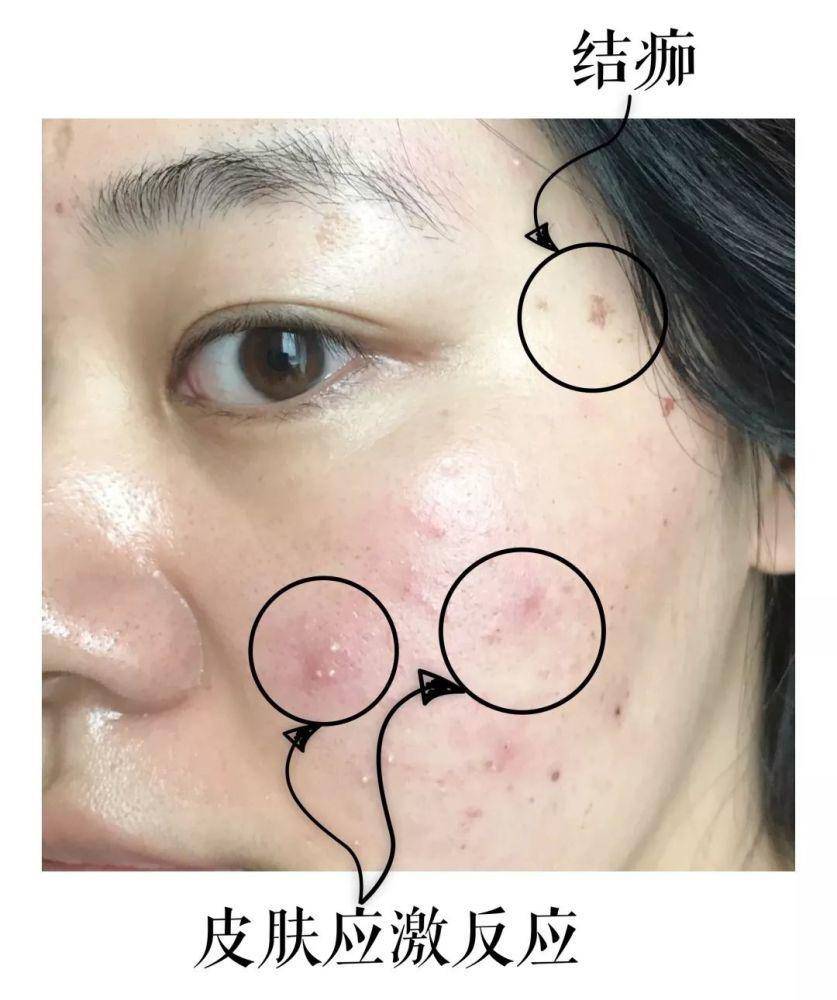 脸上有个光滑不痛不痒的小疙瘩,脸上皮肤粗糙长疙瘩是怎么回事