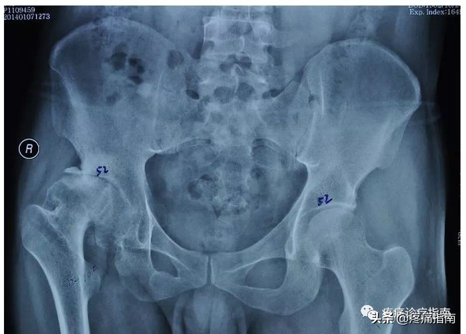 骨性关节炎诊疗方案及流程,骨性关节炎的护理诊断