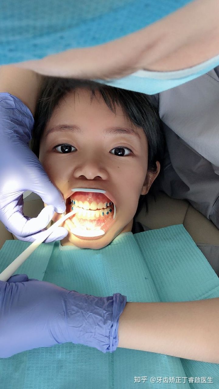 隐适美牙套矫正手法,隐适美牙套矫正的全过程