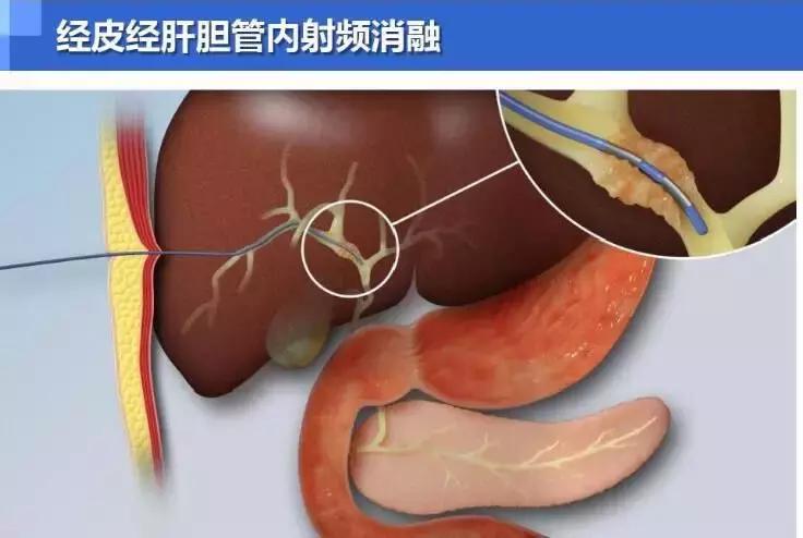 胆管恶性肿瘤保守治疗,胆道射频消融的危害